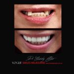 VOGUE-SMILES-COSMETIC-DENTISTRY-TREATMENT-138.jpg