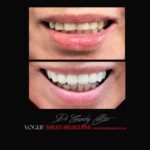 VOGUE SMILES MELBOURNE COSMETIC DENTISTRY B&A Before and After Smile Gallery photos -Top Cosmetic Dentist Melbourne