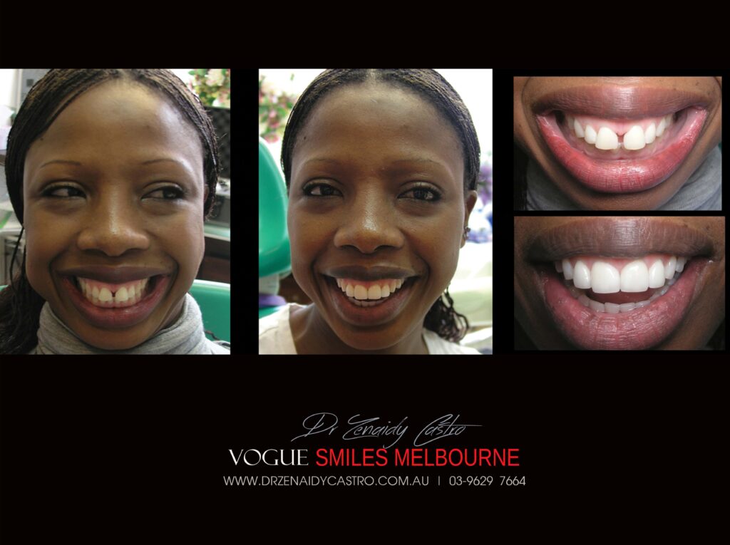 VOGUE-SMILES-COSMETIC-DENTISTRY-TREATMENT-14-scaled.jpg