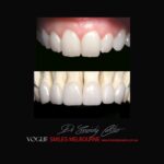 VOGUE-SMILES-COSMETIC-DENTISTRY-TREATMENT-140.jpg