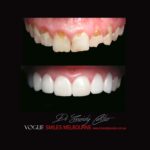 VOGUE SMILES MELBOURNE COSMETIC DENTISTRY B&A Before and After Smile Gallery photos -Top Cosmetic Dentist Melbourne