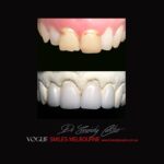 VOGUE-SMILES-COSMETIC-DENTISTRY-TREATMENT-143.jpg