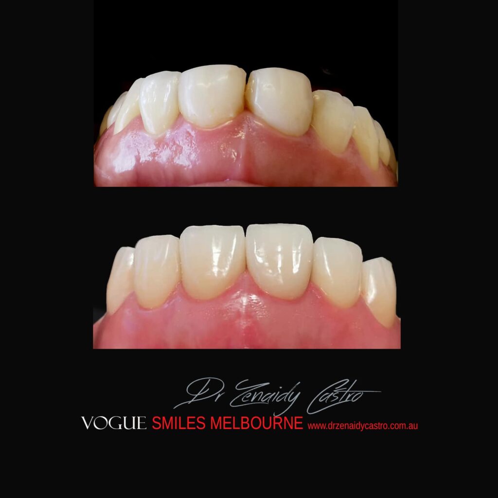 VOGUE SMILES MELBOURNE COSMETIC DENTISTRY B&A Before and After Smile Gallery photos -Top Cosmetic Dentist Melbourne