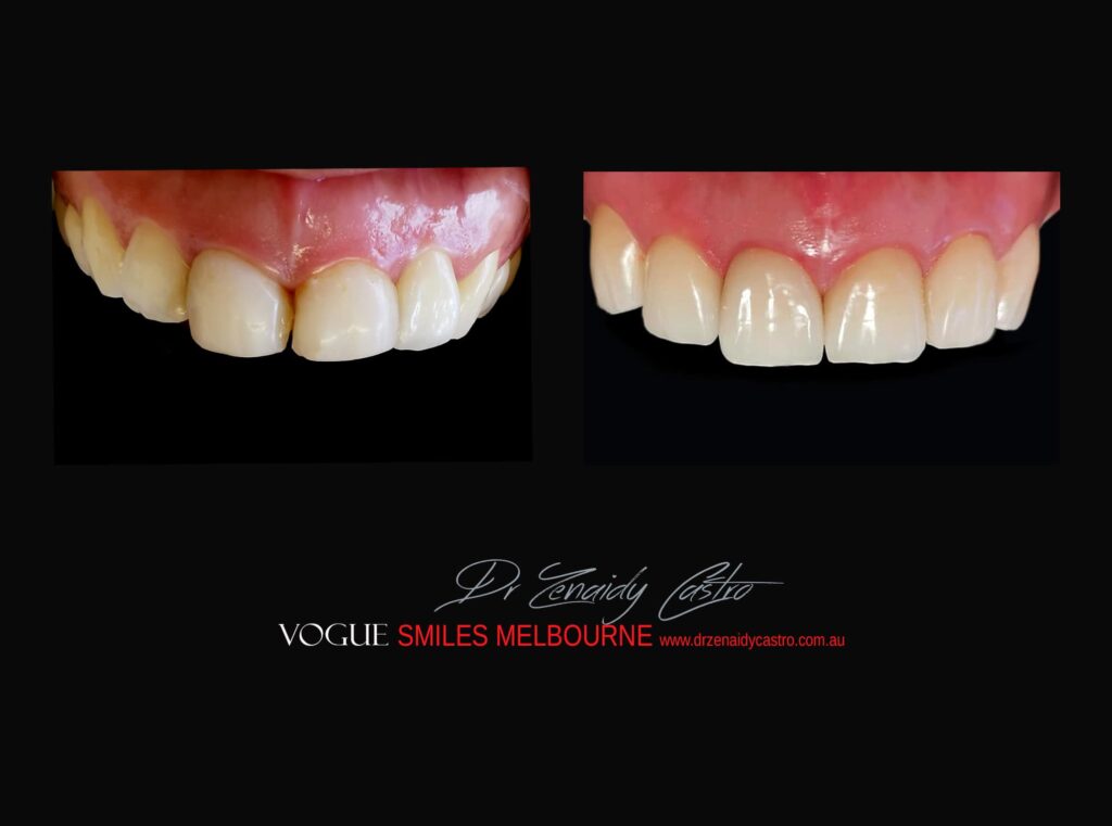VOGUE-SMILES-COSMETIC-DENTISTRY-TREATMENT-145.jpg
