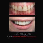 VOGUE SMILES MELBOURNE COSMETIC DENTISTRY B&A Before and After Smile Gallery photos -Top Cosmetic Dentist Melbourne