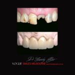 VOGUE-SMILES-COSMETIC-DENTISTRY-TREATMENT-147.jpg
