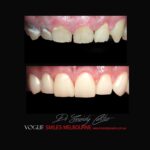 VOGUE-SMILES-COSMETIC-DENTISTRY-TREATMENT-148.jpg