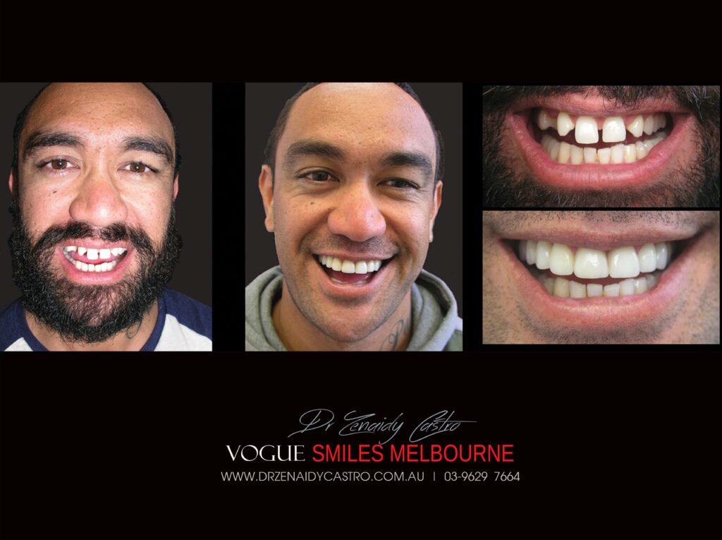 VOGUE-SMILES-COSMETIC-DENTISTRY-TREATMENT-15-scaled.jpg