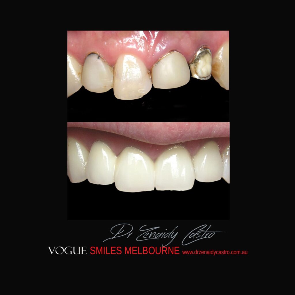 VOGUE-SMILES-COSMETIC-DENTISTRY-TREATMENT-150.jpg