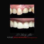 VOGUE-SMILES-COSMETIC-DENTISTRY-TREATMENT-150.jpg