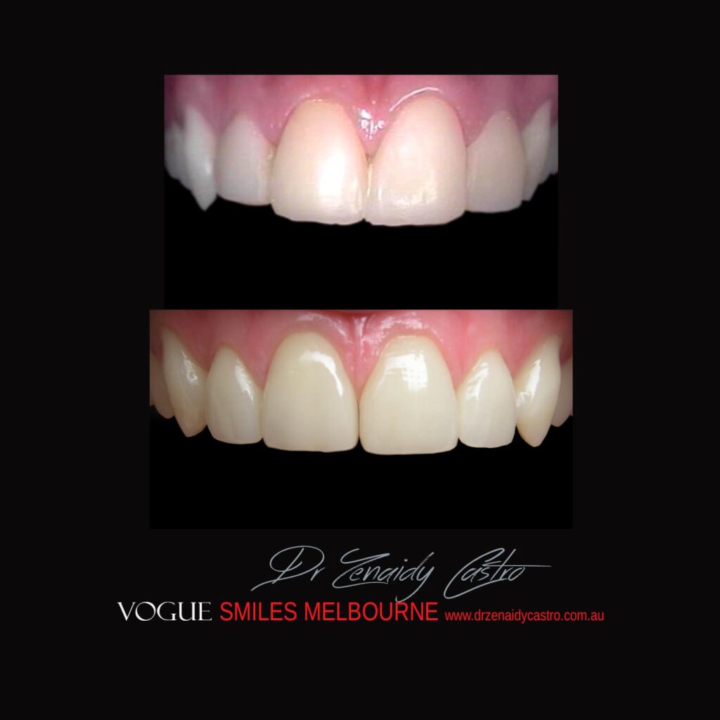 VOGUE-SMILES-COSMETIC-DENTISTRY-TREATMENT-151.jpg
