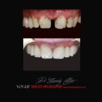 VOGUE-SMILES-COSMETIC-DENTISTRY-TREATMENT-154.jpg