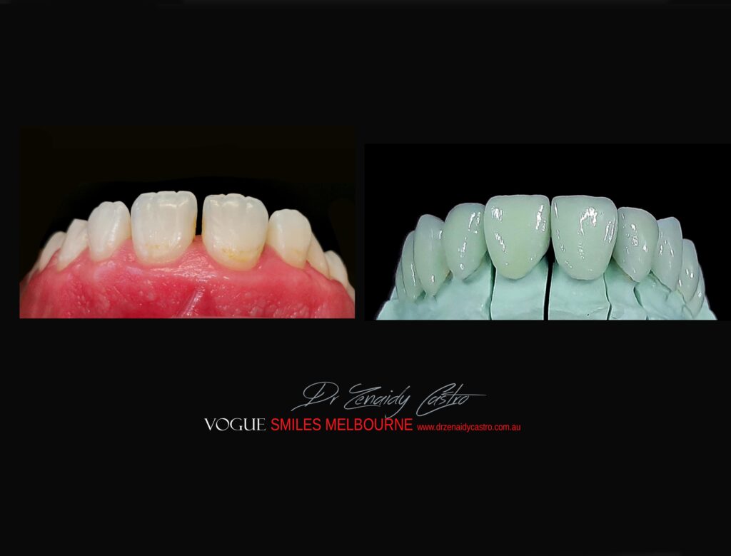 VOGUE-SMILES-COSMETIC-DENTISTRY-TREATMENT-155-scaled.jpg