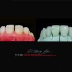 VOGUE-SMILES-COSMETIC-DENTISTRY-TREATMENT-155-scaled.jpg