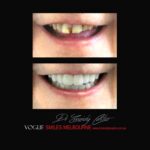 VOGUE-SMILES-COSMETIC-DENTISTRY-TREATMENT-156.jpg