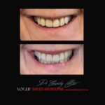 VOGUE-SMILES-COSMETIC-DENTISTRY-TREATMENT-159.jpg