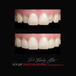 VOGUE-SMILES-COSMETIC-DENTISTRY-TREATMENT-160.jpg