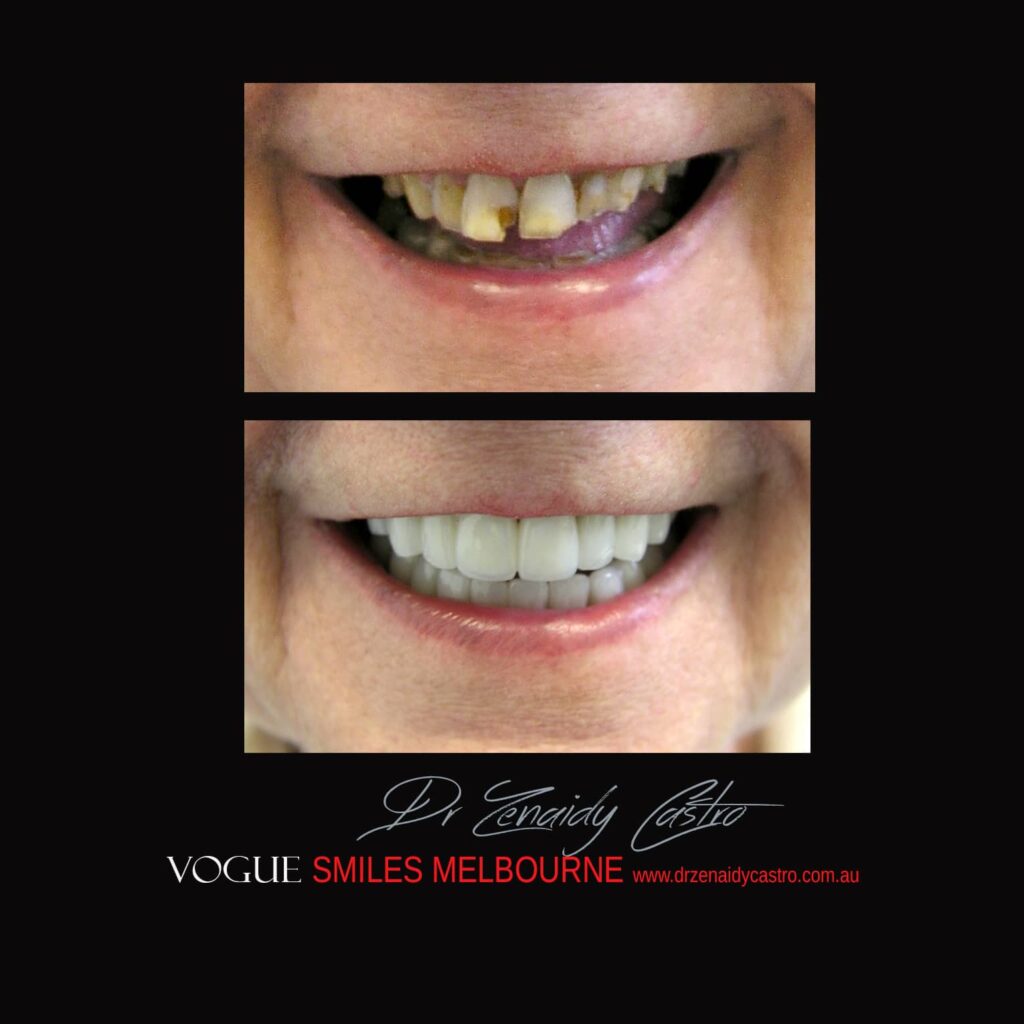 VOGUE-SMILES-COSMETIC-DENTISTRY-TREATMENT-161.jpg