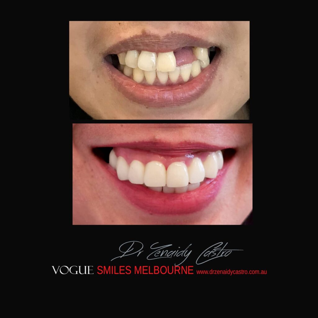 VOGUE-SMILES-COSMETIC-DENTISTRY-TREATMENT-166.jpg