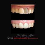 VOGUE-SMILES-COSMETIC-DENTISTRY-TREATMENT-171.jpg