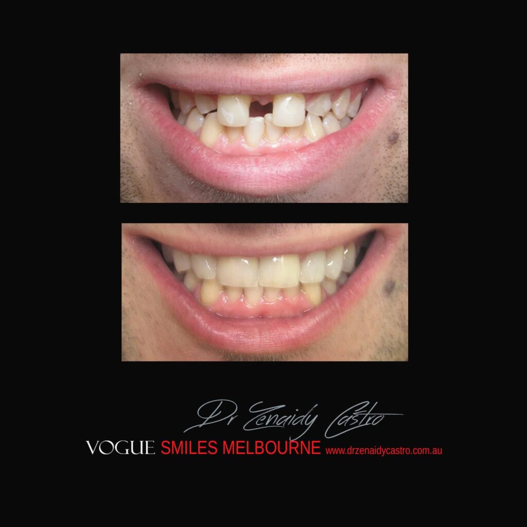 VOGUE-SMILES-COSMETIC-DENTISTRY-TREATMENT-172.jpg