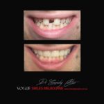 VOGUE-SMILES-COSMETIC-DENTISTRY-TREATMENT-172.jpg