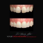 VOGUE-SMILES-COSMETIC-DENTISTRY-TREATMENT-180.jpg