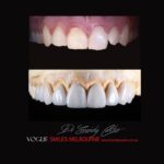 VOGUE-SMILES-COSMETIC-DENTISTRY-TREATMENT-186.jpg