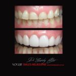VOGUE-SMILES-COSMETIC-DENTISTRY-TREATMENT-187.jpg