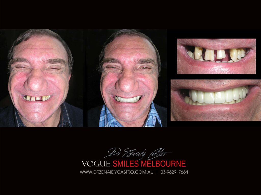 VOGUE-SMILES-COSMETIC-DENTISTRY-TREATMENT-19-scaled.jpg