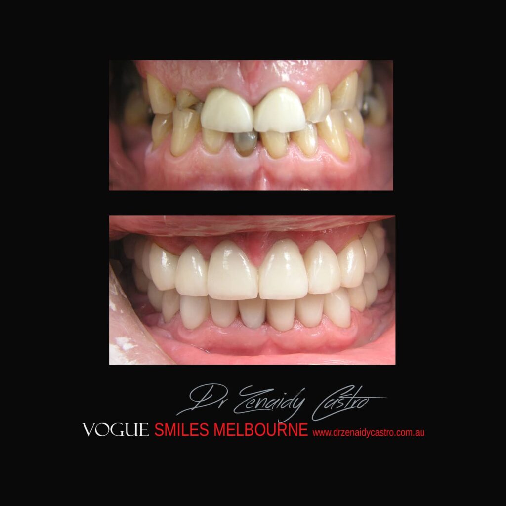 VOGUE-SMILES-COSMETIC-DENTISTRY-TREATMENT-190.jpg