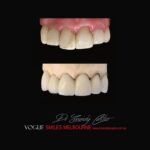 VOGUE-SMILES-COSMETIC-DENTISTRY-TREATMENT-192.jpg