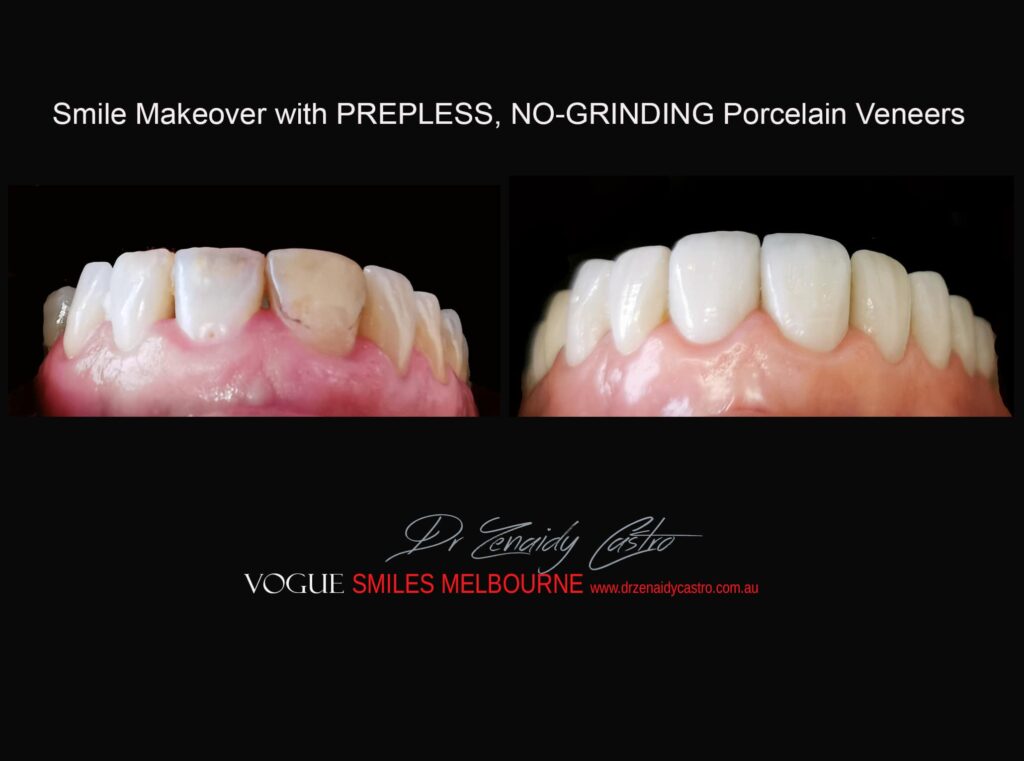 VOGUE-SMILES-COSMETIC-DENTISTRY-TREATMENT-194.jpg