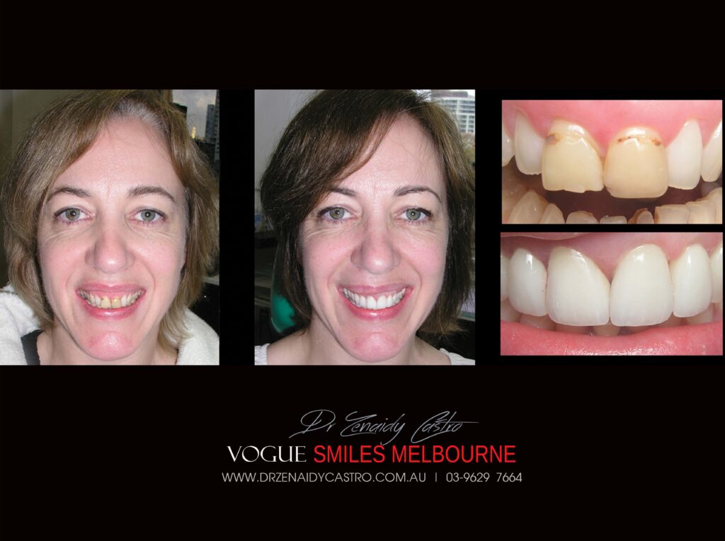 Vogue Smiles Melbourne - Vogue Dentist - Vogue Dental Melbourne -Best Cosmetic dentist in Melbourne CBD