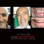 VOGUE-SMILES-COSMETIC-DENTISTRY-TREATMENT-20-scaled.jpg