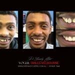 VOGUE-SMILES-COSMETIC-DENTISTRY-TREATMENT-21-scaled.jpg