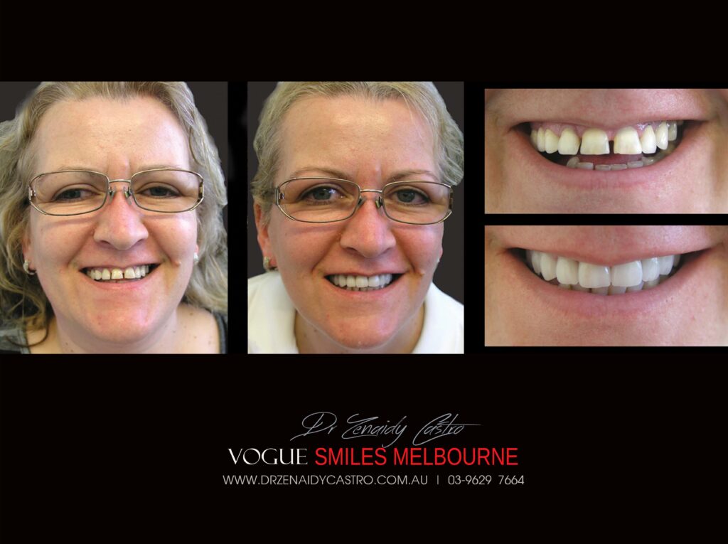 Vogue Smiles Melbourne - Vogue Dentist - Vogue Dental Melbourne -Best Cosmetic dentist in Melbourne CBD