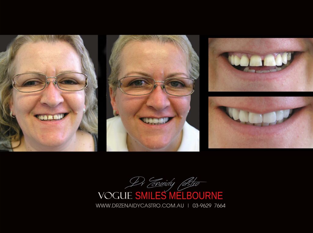 VOGUE-SMILES-COSMETIC-DENTISTRY-TREATMENT-22-scaled.jpg