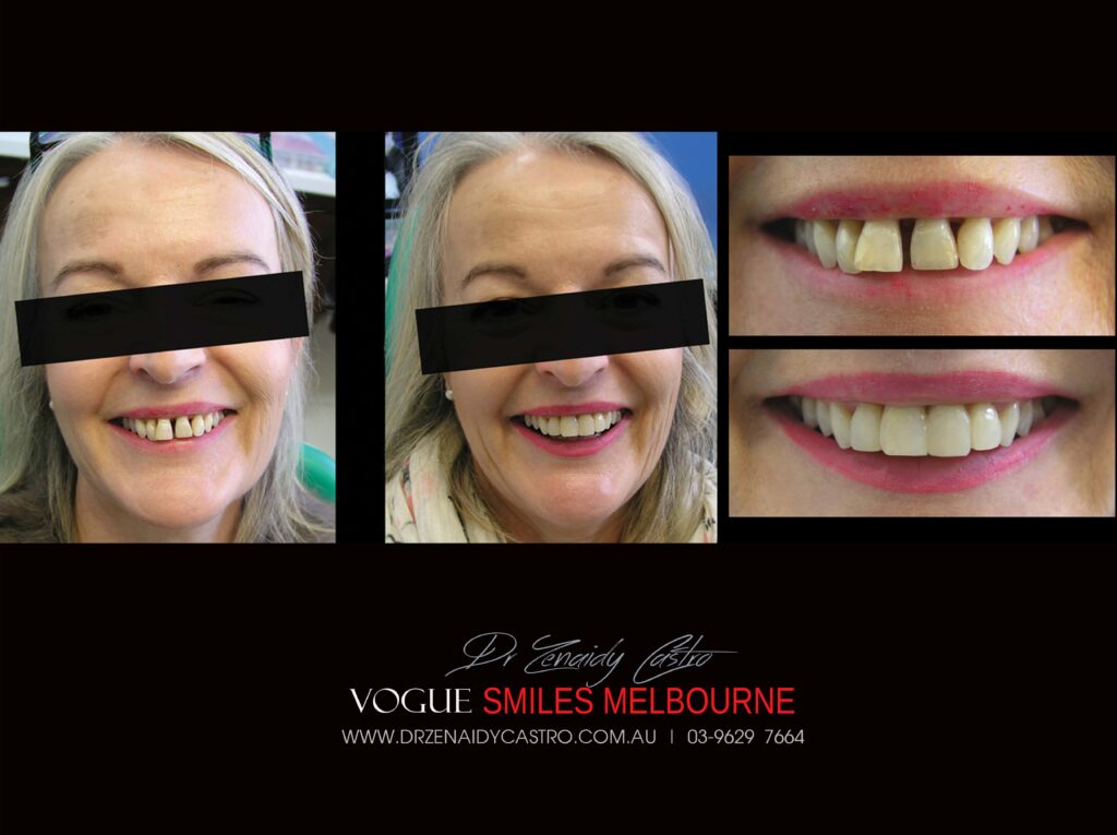 Vogue Smiles Melbourne - Vogue Dentist - Vogue Dental Melbourne -Best Cosmetic dentist in Melbourne CBD