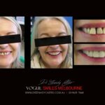 VOGUE-SMILES-COSMETIC-DENTISTRY-TREATMENT-23-scaled.jpg