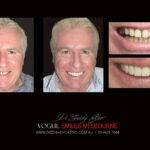 VOGUE-SMILES-COSMETIC-DENTISTRY-TREATMENT-26-scaled.jpg