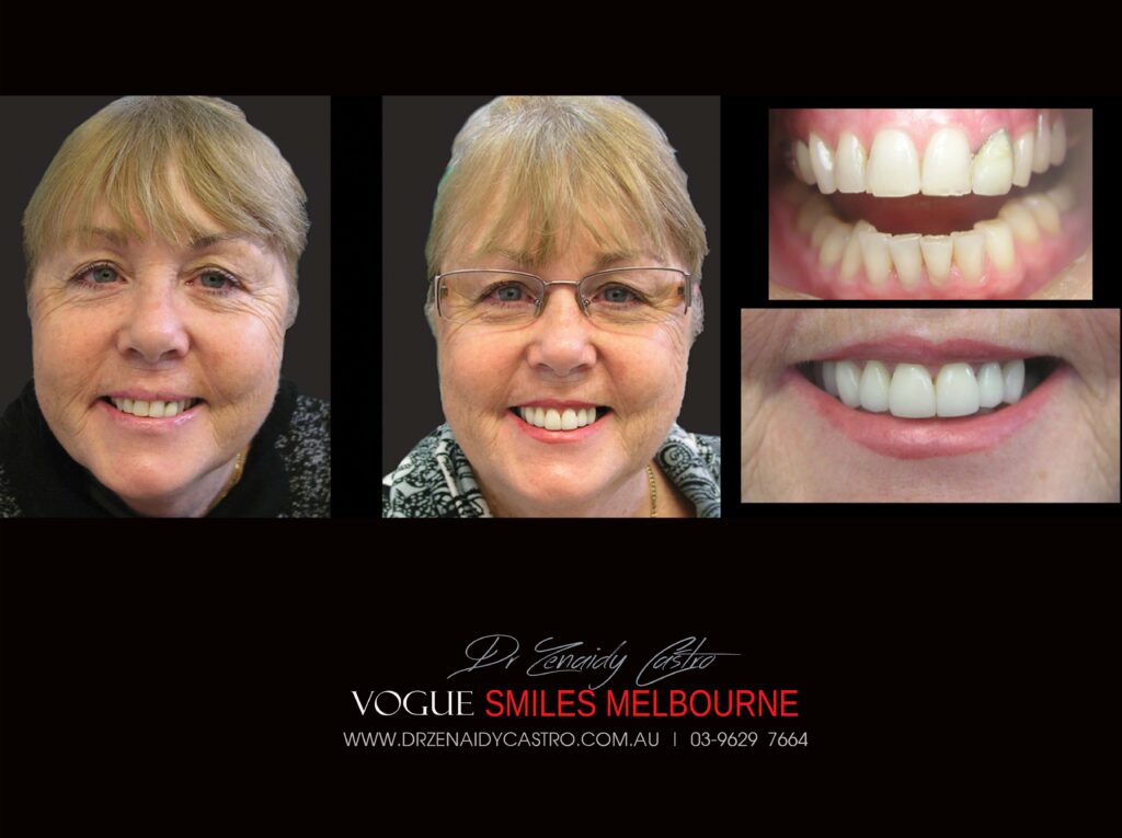 Vogue Smiles Melbourne - Vogue Dentist - Vogue Dental Melbourne -Best Cosmetic dentist in Melbourne CBD
