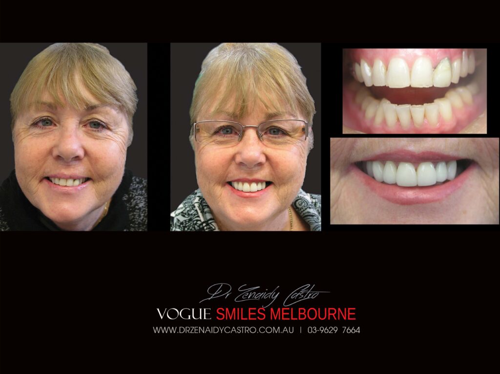 VOGUE-SMILES-COSMETIC-DENTISTRY-TREATMENT-27-scaled.jpg