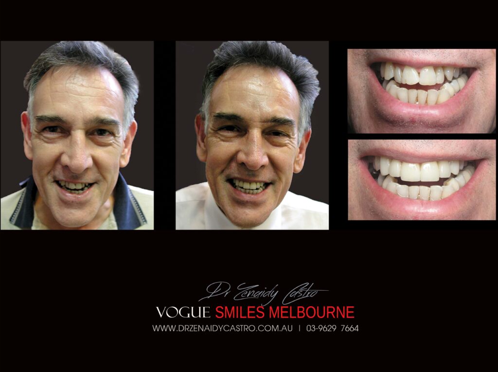 VOGUE-SMILES-COSMETIC-DENTISTRY-TREATMENT-28-scaled.jpg