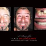 VOGUE-SMILES-COSMETIC-DENTISTRY-TREATMENT-3-scaled.jpg