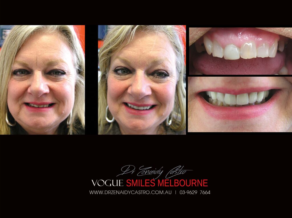 Vogue Smiles Melbourne - Vogue Dentist - Vogue Dental Melbourne -Best Cosmetic dentist in Melbourne CBD