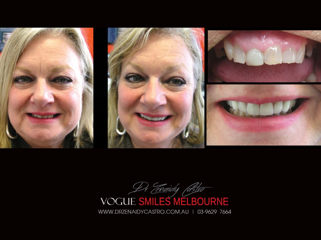 VOGUE-SMILES-COSMETIC-DENTISTRY-TREATMENT-32-scaled.jpg