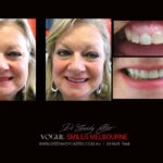 VOGUE-SMILES-COSMETIC-DENTISTRY-TREATMENT-32-scaled.jpg