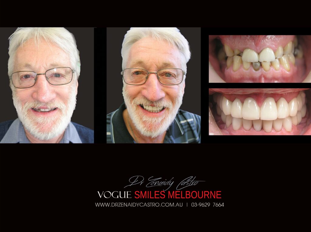 Full Mouth Reconstructions Melbourne Before and After