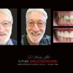 Full Mouth Reconstructions Melbourne Before and After